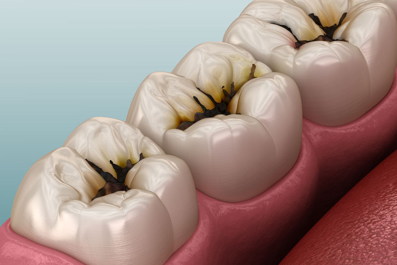 dental cavity graphic