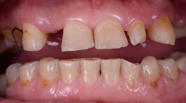 dental implants before 2