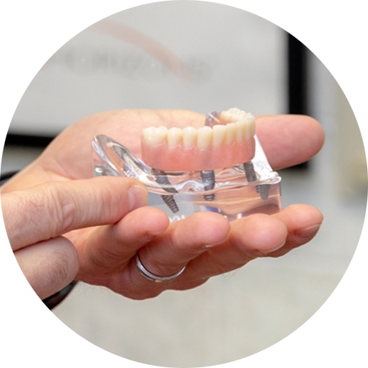 dental implants mode