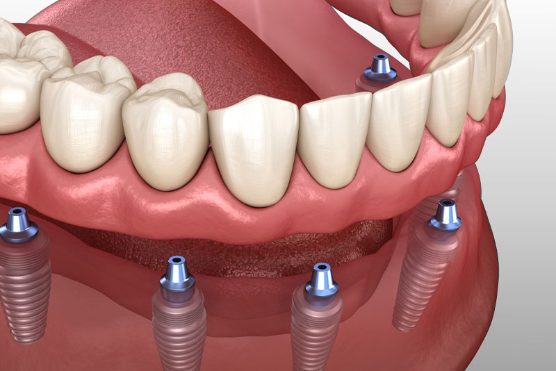 implant supported dentures model 3