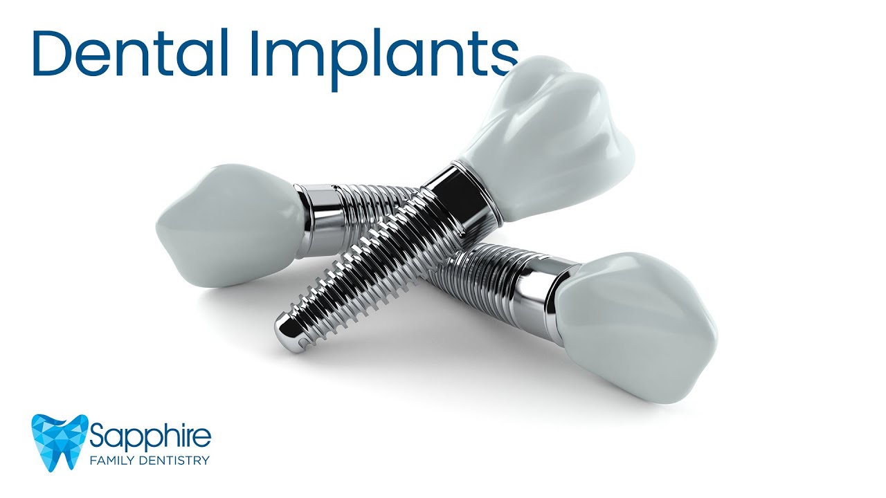 Prevent Tooth Shifting and Bone Loss with Dental Implants
