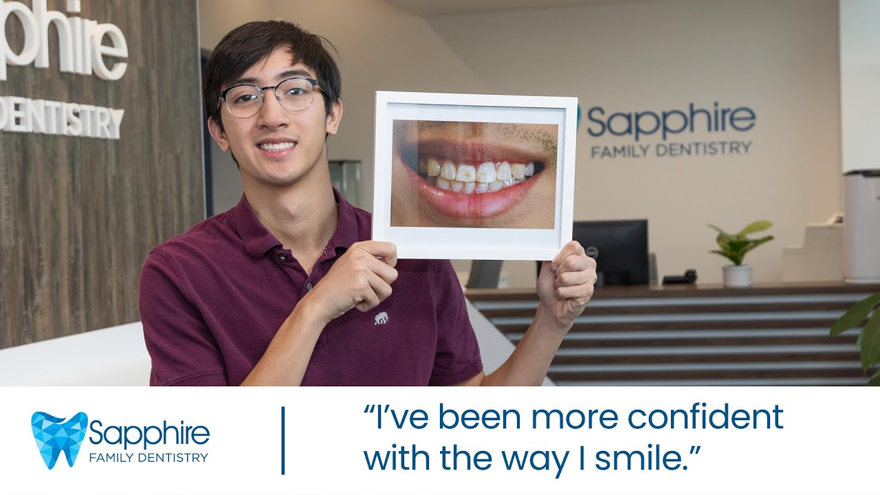 I Smile Much More Often with My Veneers