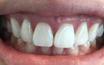 A teeth whiteing