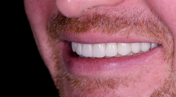 after dental implants