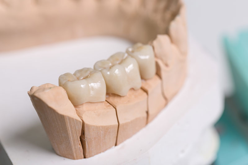 dental bridge model 1