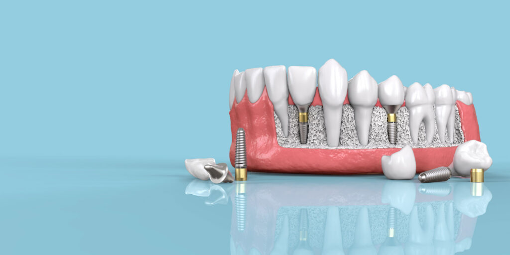 dental implant model 2