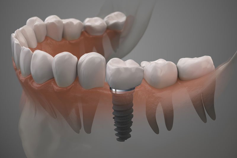 dental implants graphic 1