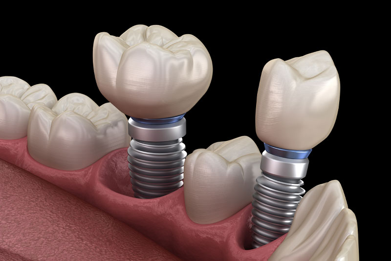 dental implants model 2 2